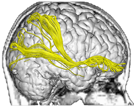 Severe TBI bottomleft.brain