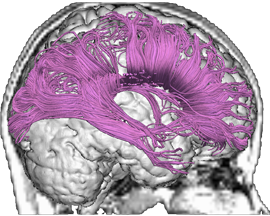 Mild Traumatic Brain Injury topright.brain